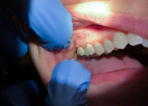 Best Dentist for Tooth Abscess  in Sicklerville, NJ